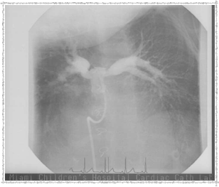 Catheterization 2003 - Balloon