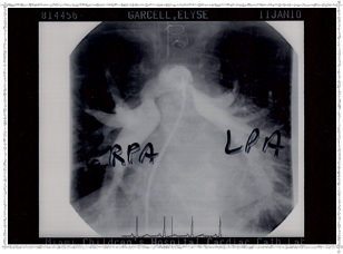 2010 - Left Pulmonary Artery After