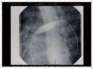 2010 - Pulmonary Artery Ballooned